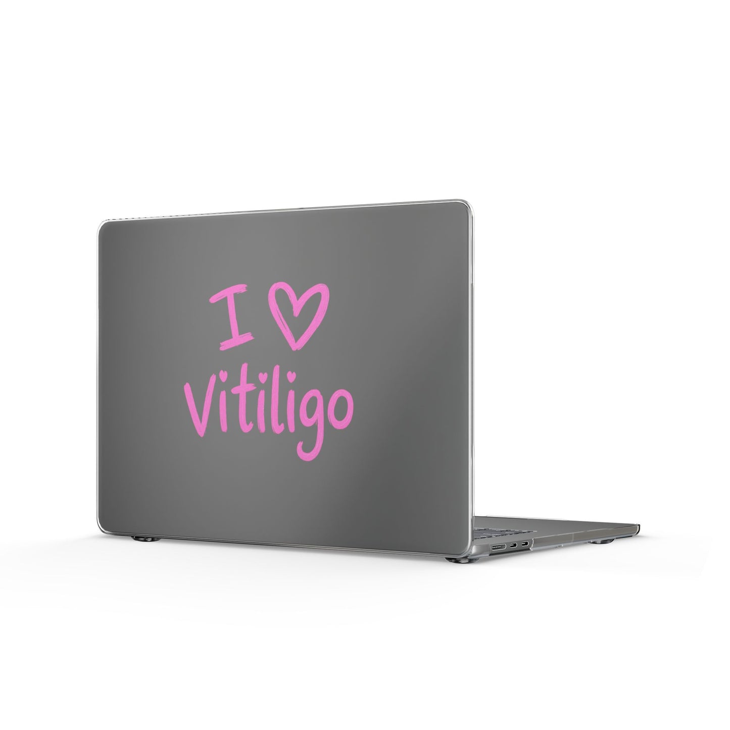 Clear MacBook Case — I  Vitiligo Pink Pride Laptop Cover